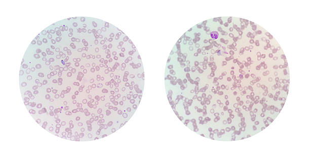 istock Microscopic views of a thin blood smear from malaria patient 613134870