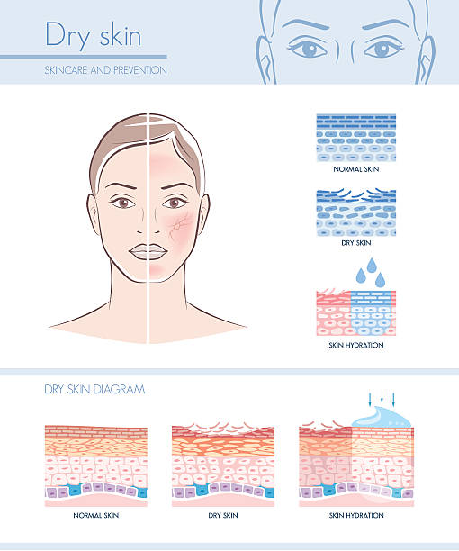 Dry skin Dry skin hydration infographic with skin diagram; skincare and beauty concept skin stock illustrations