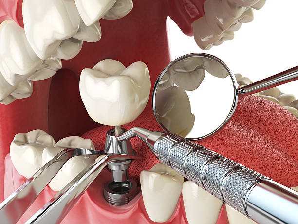 impianto umano dentale. concetto di impianto dentale. denti umani o - impianto dentale foto e immagini stock