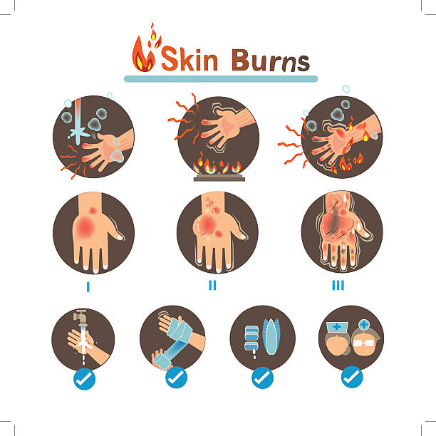 Burns Degree Burns and Thermal Burns Treatment,Vector illustrations burning stock illustrations