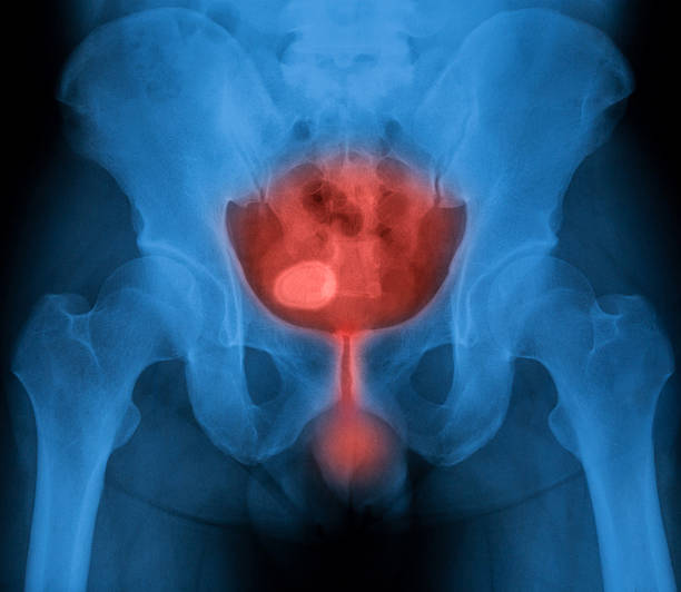 image radiographique de la vessie, vue en décubitus dorsal - hip femur ilium pelvis photos et images de collection