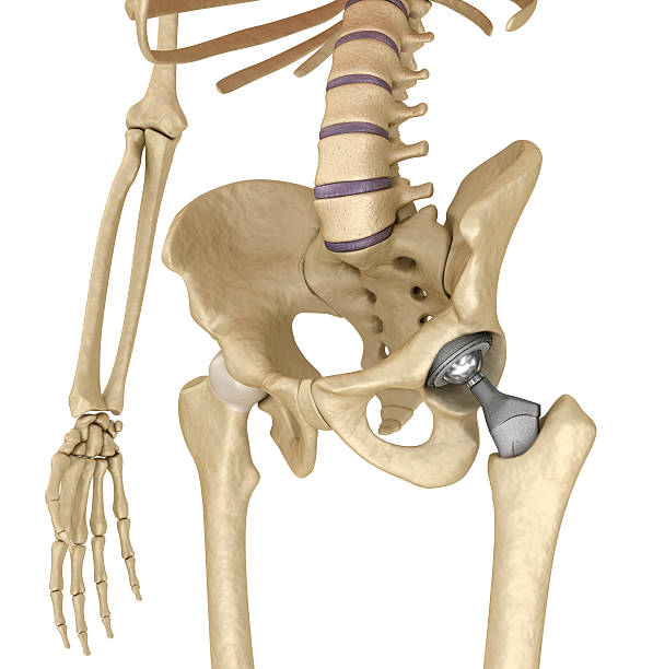 istock Hip replacement implant installed in the pelvis bone. 613870378