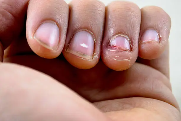 A broken fingernail extreme