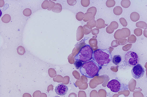 mikrograph der akuten myeloischen leukämie - wissenschaftliche mikroskopische aufnahme stock-fotos und bilder