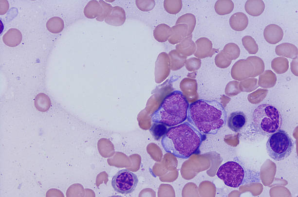 急性骨髄性白血病の顕微鏡写真 - blood cell blood red blood cell microscope ストックフォトと画像