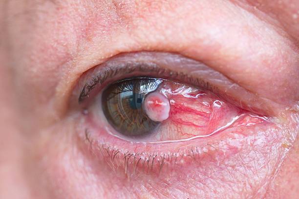 Close up of the conjunctival squamous cell carcinoma stock photo
