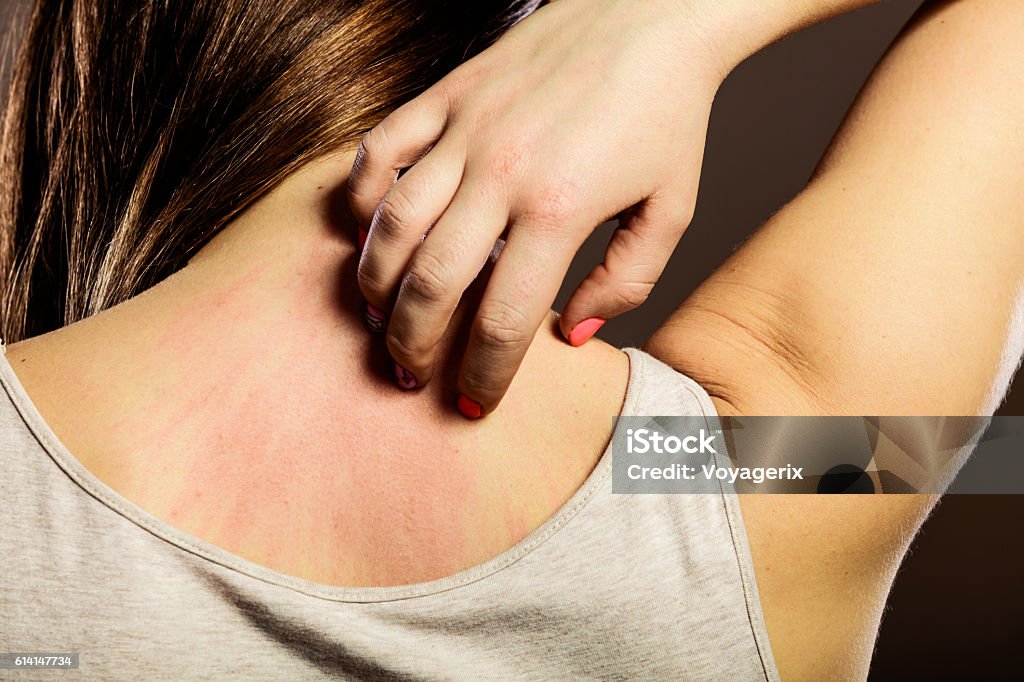 Woman scratching her back closeup Health problem. Closeup young woman scratching her itchy back with allergy rash Scratching Stock Photo