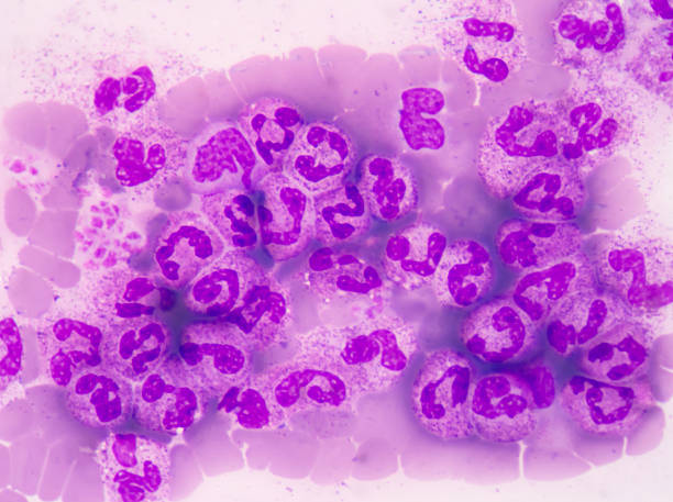 istock abnormal neutrophil in pleural fluid smear 614226140