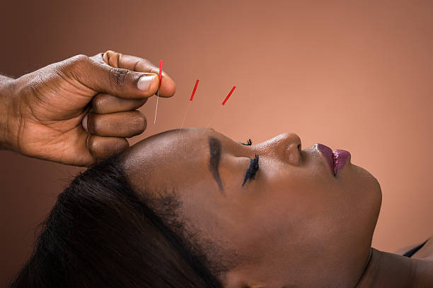 une jeune femme reçoit un traitement d’acupuncture - acupuncturist photos et images de collection