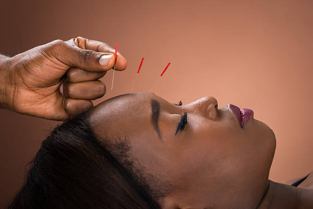 Young Woman Getting Acupuncture Treatment Close-up Of Young African Woman Receiving Acupuncture Treatment At Spa acupuncture photos stock pictures, royalty-free photos & images