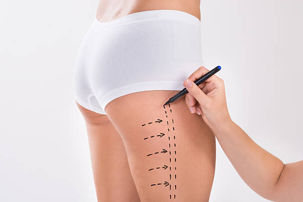 istock Surgeon Preparing Woman For Liposuction Surgery On Thigh 614441426
