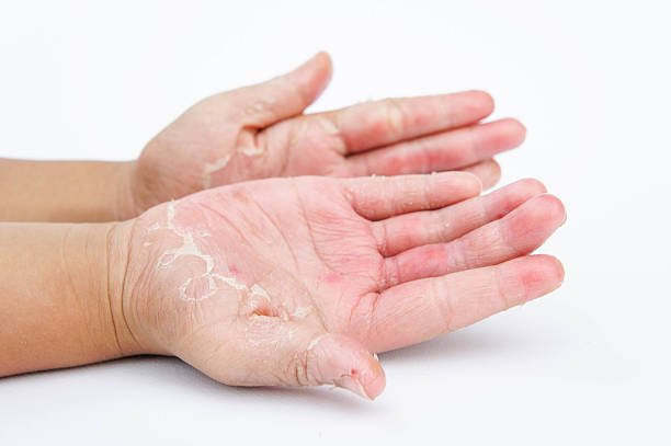syndrome mains pieds effets secondaires chimio chimiothérapie sécheresse cutanée dessèchement de la peau cloques