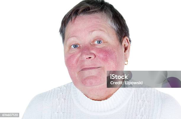 Foto de Rosacea Distúrbio Da Pele Facial Retrato De Idosa Infeliz e mais fotos de stock de Rosácea - Irritação cutânea