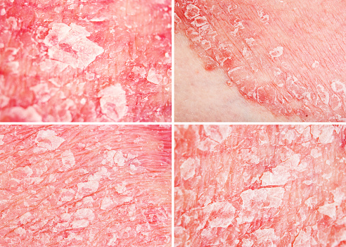 Psoriasis Vulgaris, details of psoriatic skin disease, skin patches are typically red, itchy, and scaly, collage, macro with narrow focus