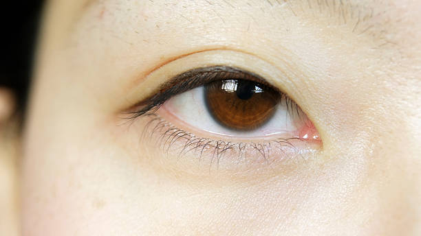 Webbed Eyelids