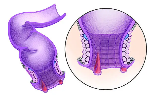 Hemorrhoids : Anal disorders in details, xray view. Medical accurate 3D illustration