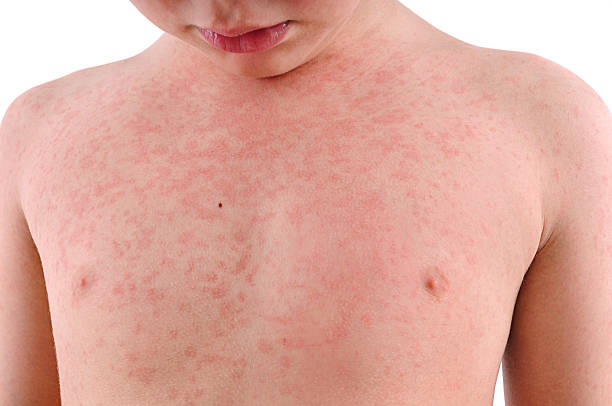 Nettle Rash Isolated Child's Body Suffering Urticaria       measles stock pictures, royalty-free photos & images