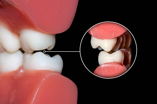 zahnocclusion molars zähne aus nächster nähe - occlusio stock-fotos und bilder