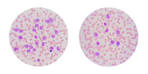 Microscopic view of a blood smear from leukemia patient showing many abnormal white blood cells, blood cancer cells or leukemia cells.