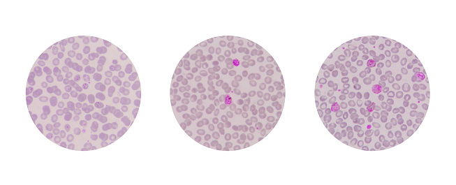 Microscopic examination of blood films from malaria infected patients showing the morphology of malaria parasite stages in human red blood cells. Trophozoites (rings), Schizonts, and Gametocytes.