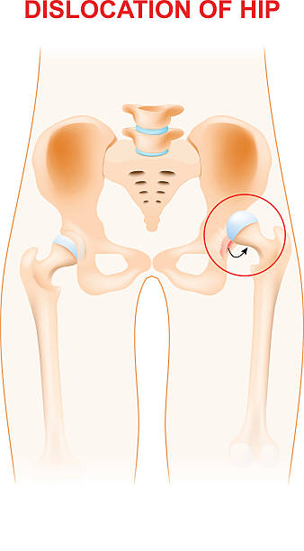 Dislocation of hip Dislocation of hip. A hip dislocation takes place when the head of the thigh bone is forced out of its socket in the pelvic bone. sports head injury stock illustrations