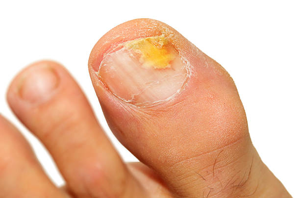 onicomicose infecção fúngica da unha. - fungus toenail human foot onychomycosis - fotografias e filmes do acervo