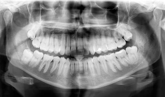 Panoramic dental X-Ray of teeth. Monochrome facial image.