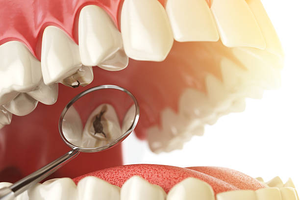 menschlicher zahn mit karies, loch und werkzeugen. zahnsuche concep - dentist dental hygiene dental drill dentist office stock-fotos und bilder