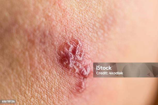 Shingles Stock Photo - Download Image Now - Shingles, Skin Condition, Blister