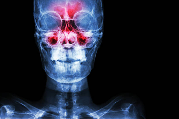 Sinusitis Sinusitis. film x-ray skull AP ( anterior - posterior ) show infection and inflammation at frontal sinus , ethmoid sinus , maxillary sinus and blank area at right side sinusitis photos stock pictures, royalty-free photos & images