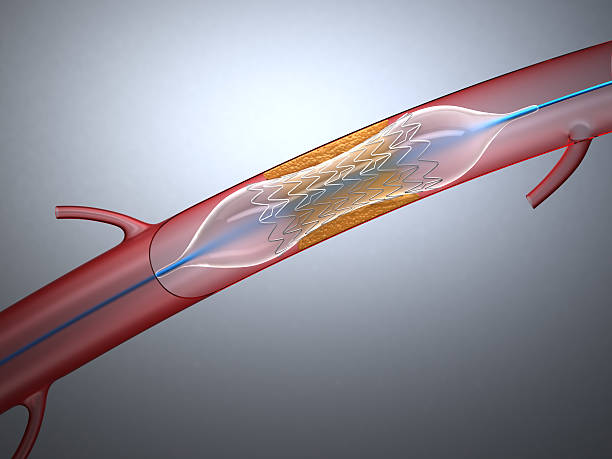 심장동맥성형술 - angioplasty 뉴스 사진 이미지