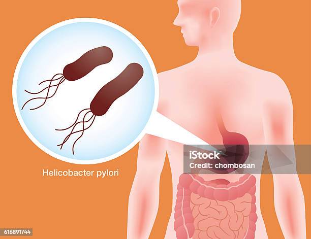 Human Stomach And Helicobacter Pylori Stock Illustration - Download Image Now - Helicobacter Pylori, Abdomen, Animal Digestive System