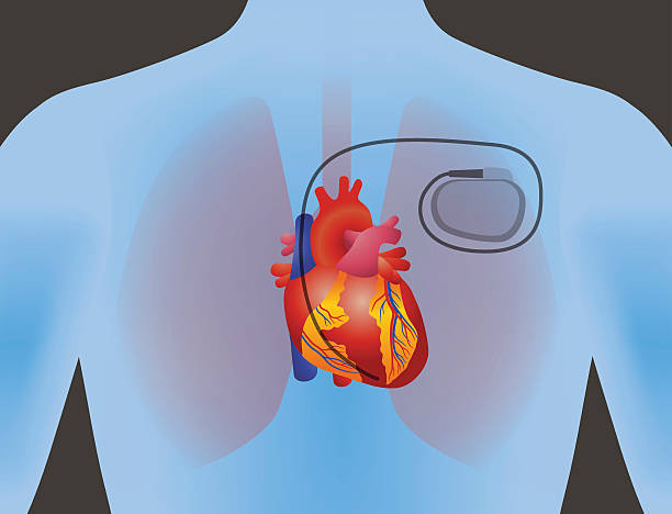 illustrations, cliparts, dessins animés et icônes de le cœur du stimulateur cardiaque humain et artificiel - valvule humaine