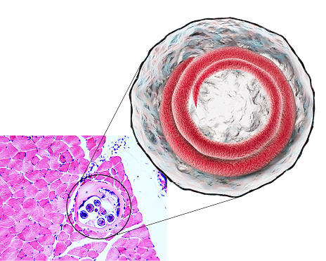 3D illustration and micrograph, transverse section, of cyst in muscle containing helminth Trichinella spiralis, nematode larval cyst in muscle tissue, transmitted by ingestion of undercooked meat