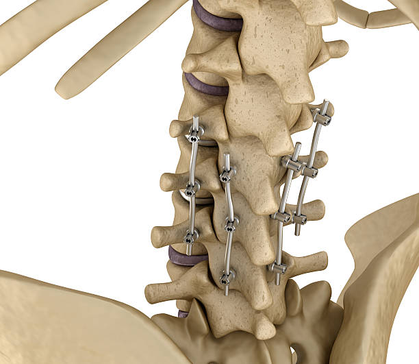 척추 고정 시스템 - 티타늄 브래킷. - human spine chiropractor three dimensional shape healthcare and medicine 뉴스 사진 이미지