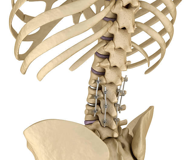 sistema di fissazione spinale - staffa in titanio. - human spine chiropractor three dimensional shape healthcare and medicine foto e immagini stock