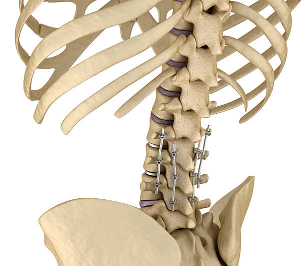 척추 고정 시스템 - 티타늄 브래킷. - human spine chiropractor three dimensional shape healthcare and medicine 뉴스 사진 이미지