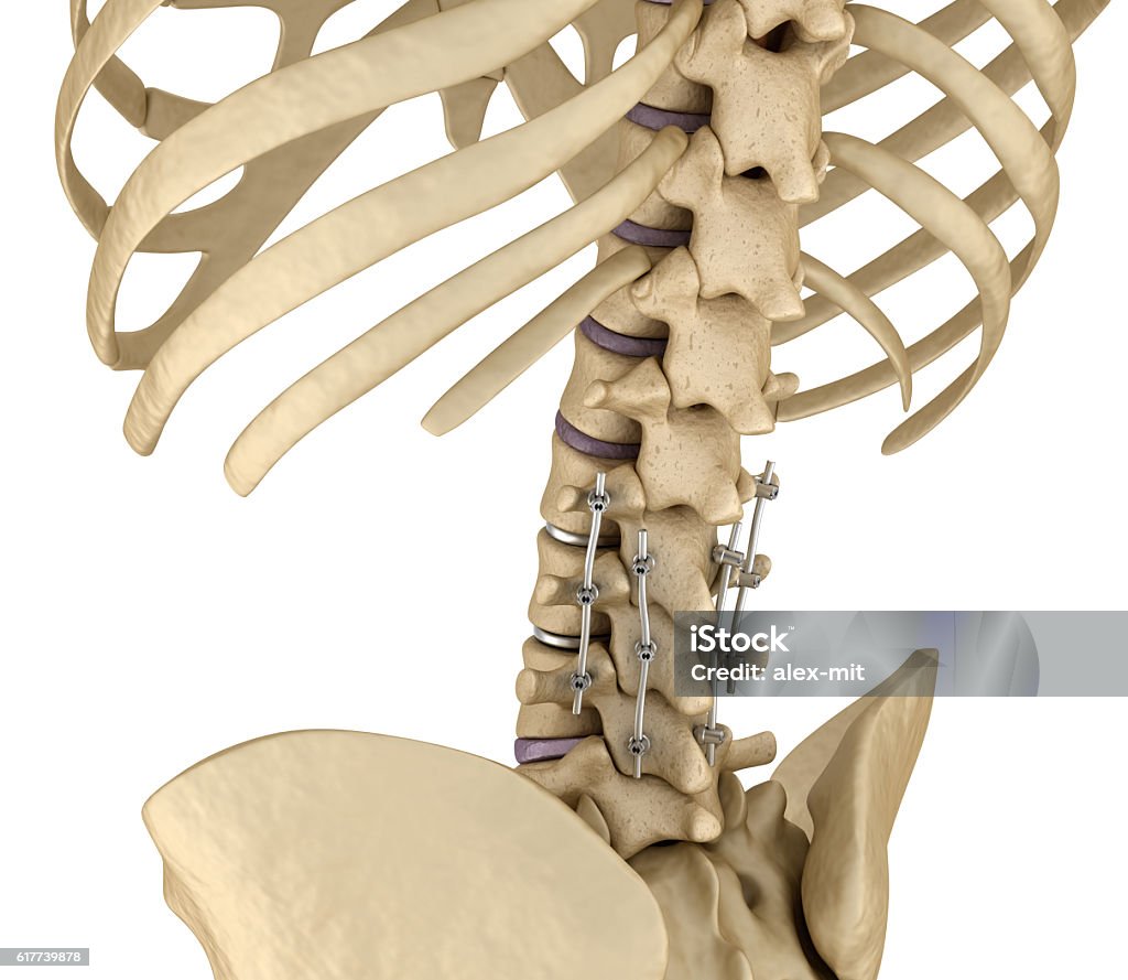 Spinal fixation system - titanium bracket. Spinal fixation system - titanium bracket. Medically accurate tooth 3D illustration Spine - Body Part Stock Photo