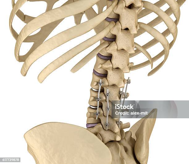Spinal Fixation System Titanium Bracket Stock Photo - Download Image Now - Spine - Body Part, Screw, Anatomy