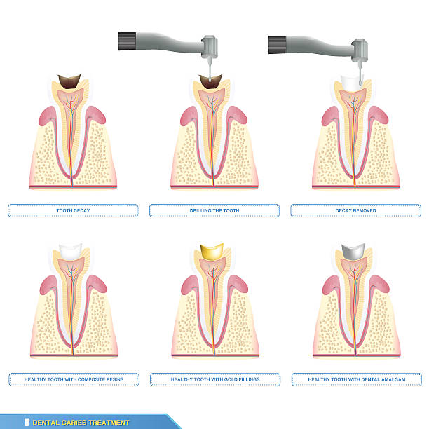 Essentials of Dental Caries デンタルカリエス デンタルカリエス