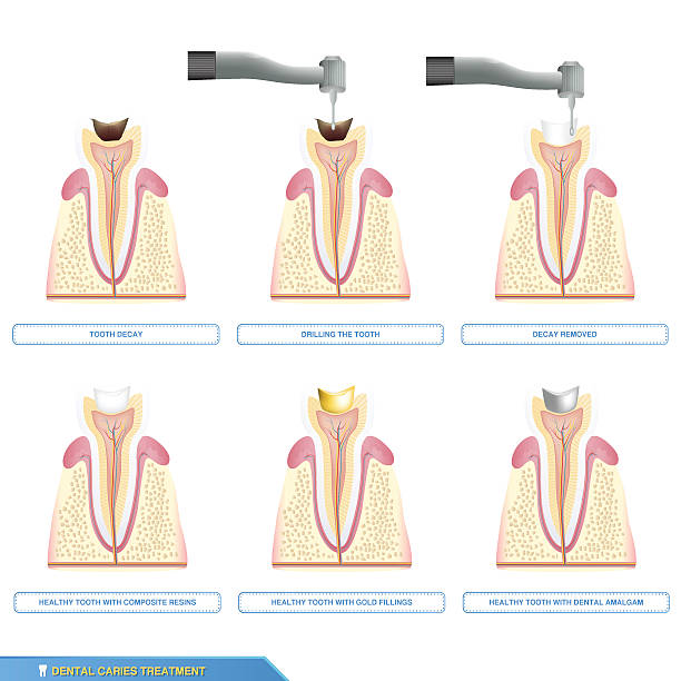 dental caries treatment and the different types of tooth Infographics dental caries treatment and the different types of tooth fillings, composite resins, dental amalgam, gold fillings dental gold crown stock illustrations