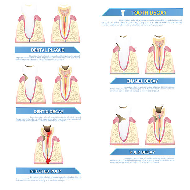 infografika próchnica stomatologiczna, etapy próchnicy zębów - human teeth gums dental hygiene inflammation stock illustrations
