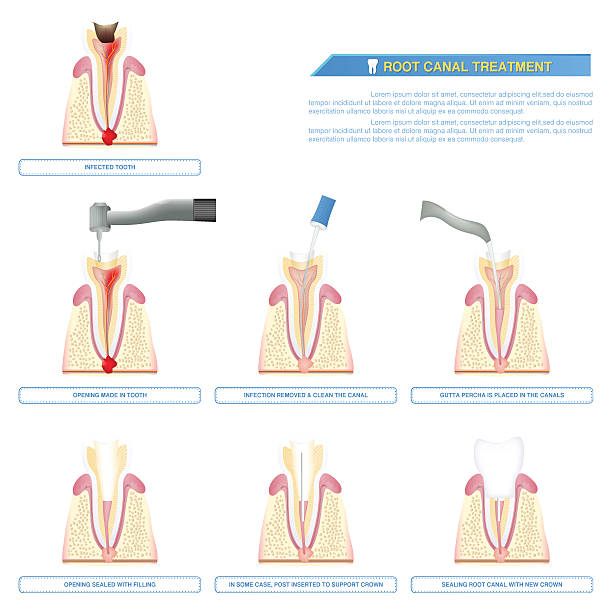 ilustrações, clipart, desenhos animados e ícones de tratamento do canal radicular infográfico, estágios da terapia do canal radicular - tatar