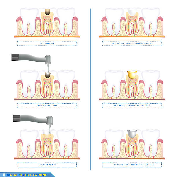 dental caries treatment and the different types of tooth fillings Infographics dental caries treatment and the different types of tooth fillings, composite resins, dental amalgam, gold fillings dental gold crown stock illustrations