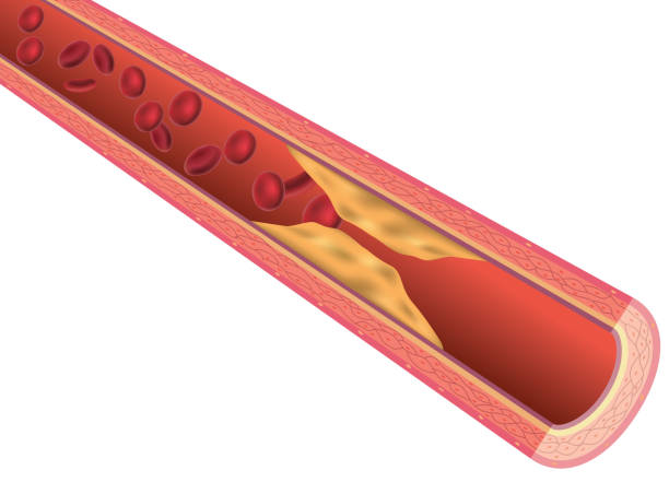 Arteriosclerosis File format is EPS10.0.  atherosclerosis stock illustrations