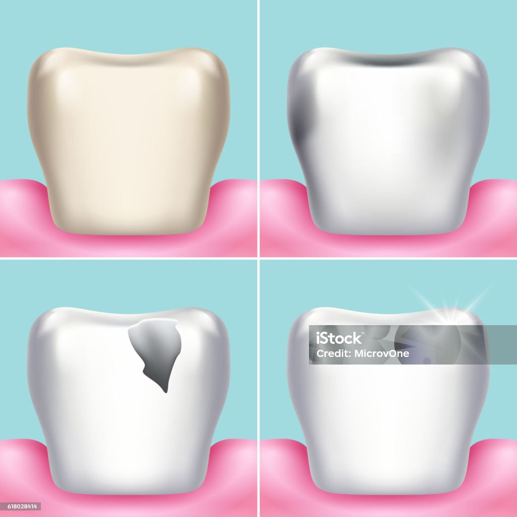 Tooth Problem Illustration Dental Problems Caries Plaque And Gum Disease Healthy Tooth Vector ...