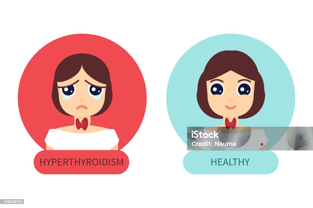Hyperthy Women With Normal And Hyperthyroid Gland Stock Illustration - Download ...