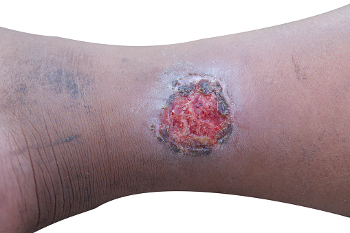 Infected wound on leg  isolated white background