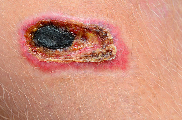 Necrotic scab on a human leg A necrotic scab on a human leg. infected wound stock pictures, royalty-free photos & images