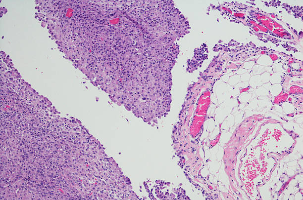 Micrograph of peritoneal Mesothelioma. Micrograph of peritoneal Mesothelioma. Mesothelioma is a rare, aggressive form of cancer that primarily develops in the lining of the lungs (pleural mesothelioma) or the abdomen (peritoneal mesothelioma). Caused by asbestos, mesothelioma has no known cure and has a poor prognosis. Generally, the earlier mesothelioma is diagnosed, the better prognosis a patient has. magnification high scale magnification scientific micrograph cell stock pictures, royalty-free photos & images